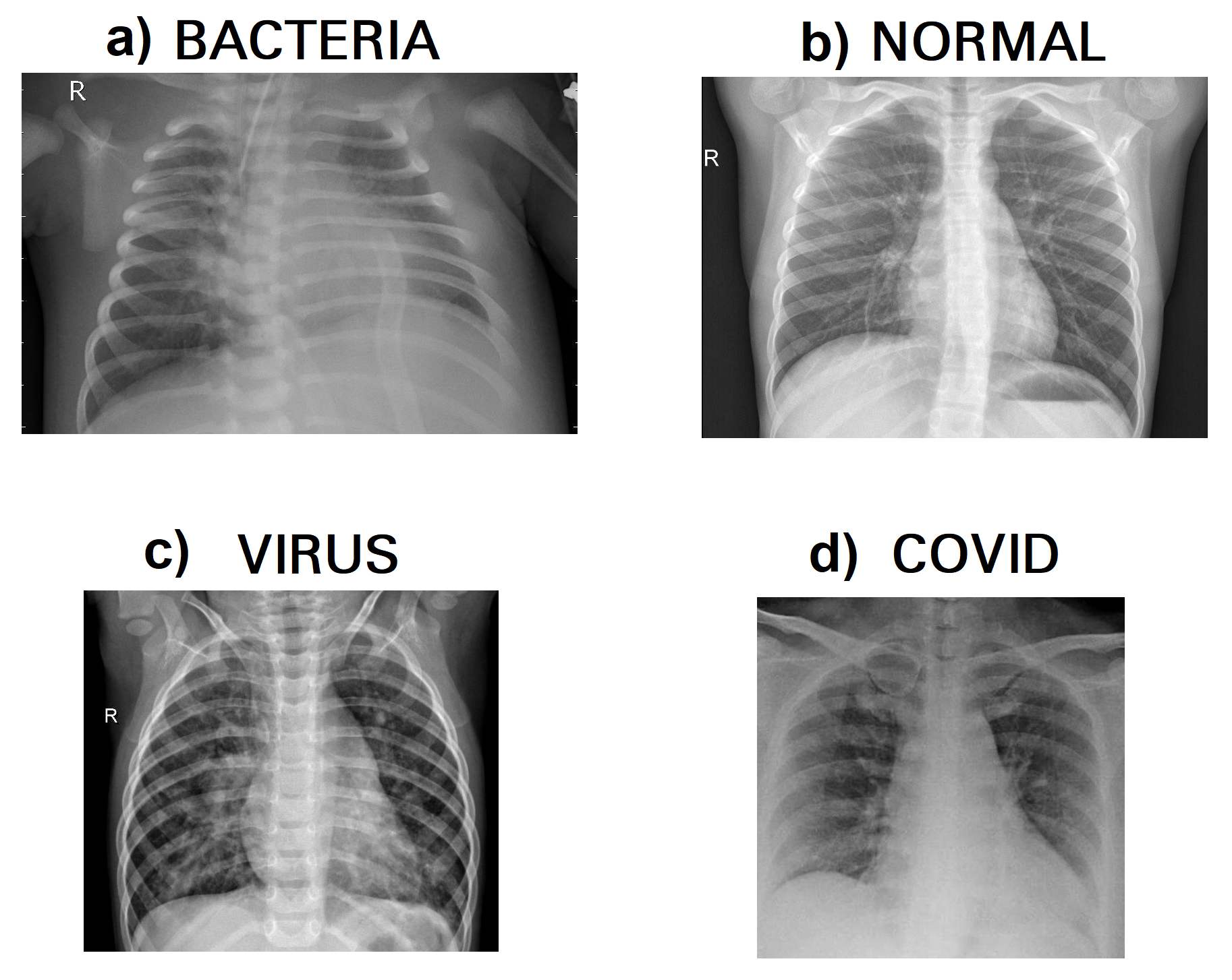 Some Chest X-ray images