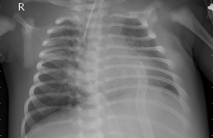 Chest X-ray image of a sick person because of bacteria shown in Figure 2a.
