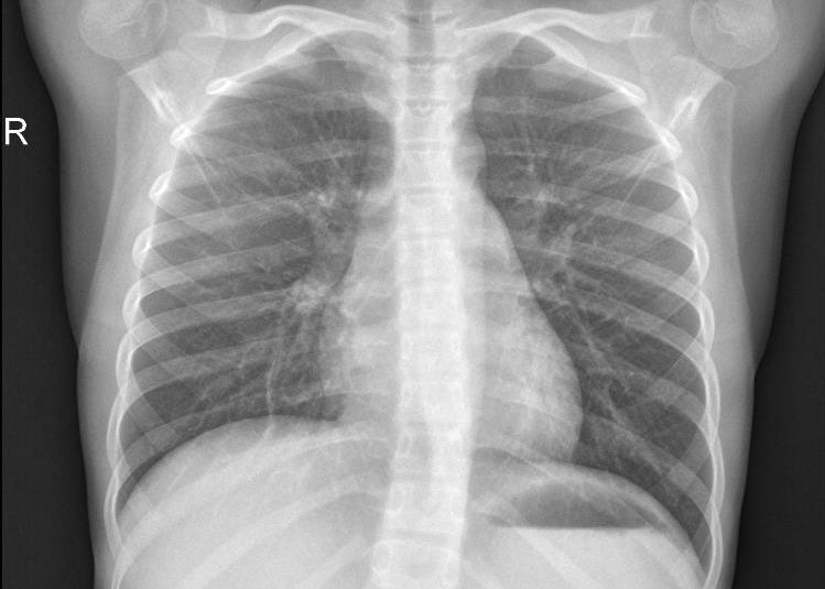 Chest X-ray image of a healthy person shown in Figure 2b.