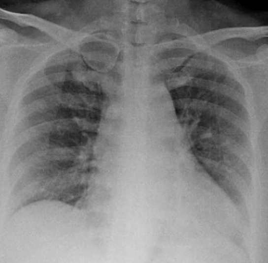 Chest X-ray image of a sick person because of COVID-19 shown in Figure 2d.